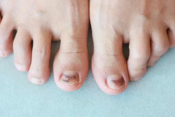 Dita dei piedi con unghie maculate marroni, forse a causa di un trauma o un fungo.