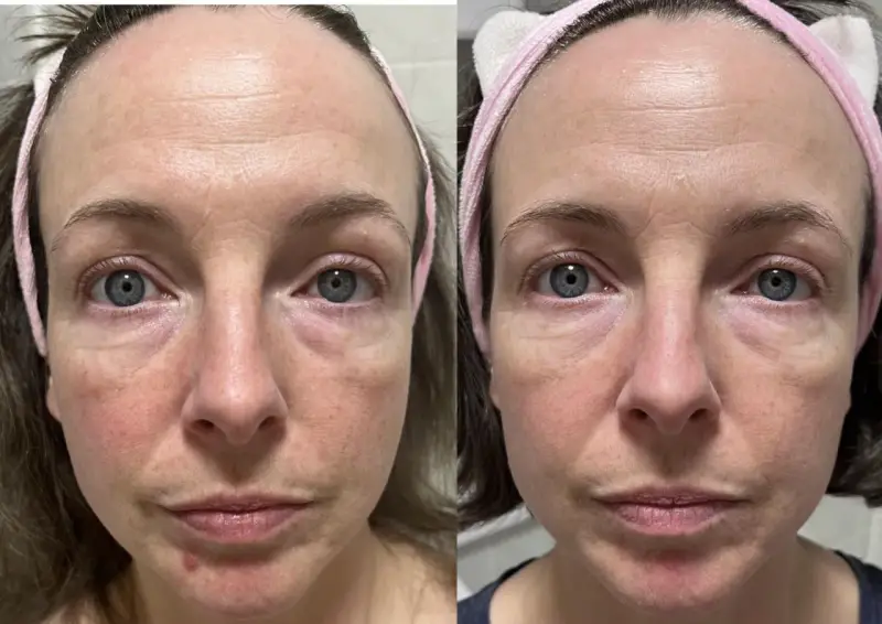 Confronto viso: pelle con niacinamide prima e dopo. Miglioramento di rossori e texture.